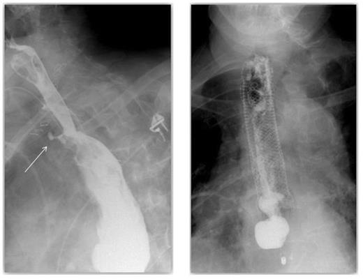A contrast swallow demonstrating contrast aggregating around the drain & A covered oesophageal stent appropriately positioned with no evidence of leak