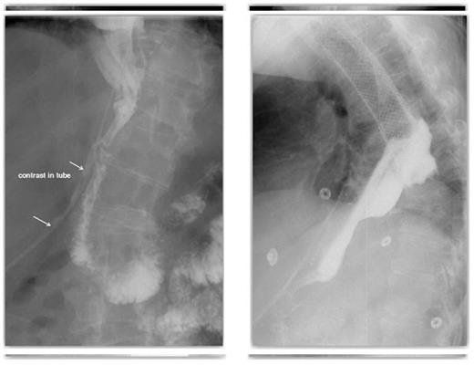 A late pyloroplasty leak diagnosed on contrast swallow & A contrast swallow demonstrating proximal stent migration and evidence of on-going leak
