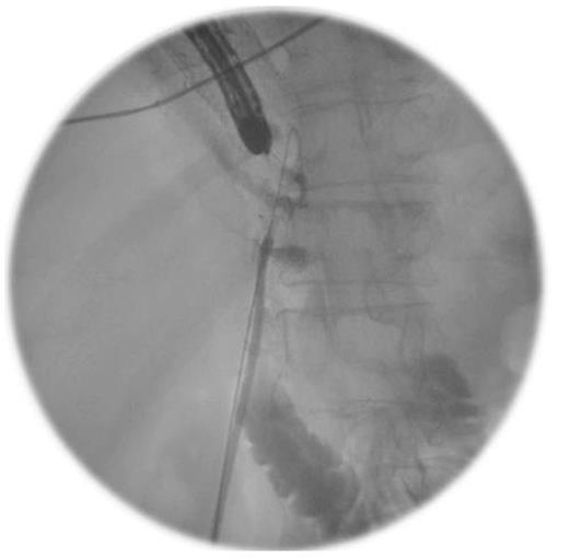 An Intra-operative image demonstrating the combined endoscopic and fluoroscopic procedure