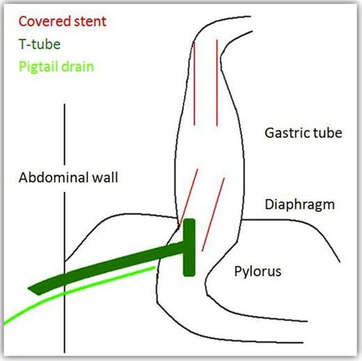 A pictorial representation of the result of the procedure