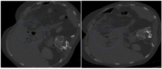 A follow-up CT demonstrating no evidence of on-going leak from the pyloroplasty & A follow-up CT demonstrating the flanged T-tube satisfactorily plugging the hole through the anterior wall of the pyloroplasty