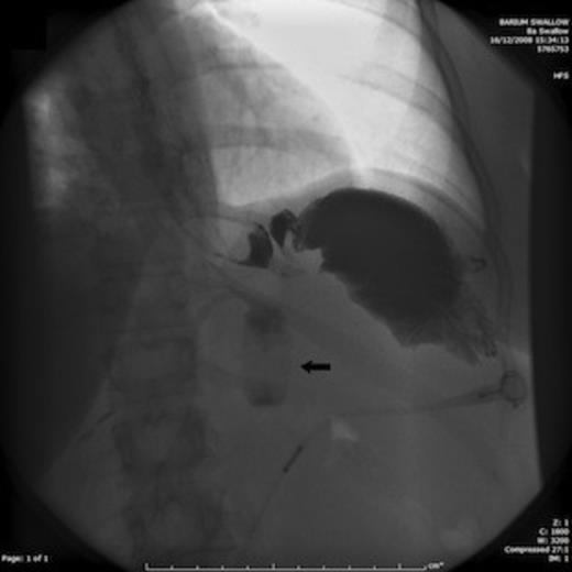 Barium swallow showing signs of mechanical obstruction with no contrast seen beyond the fundus of the stomach. The arrow demonstrates the gastric band, which was found behind the stomach acting as an axis for gastric torsion