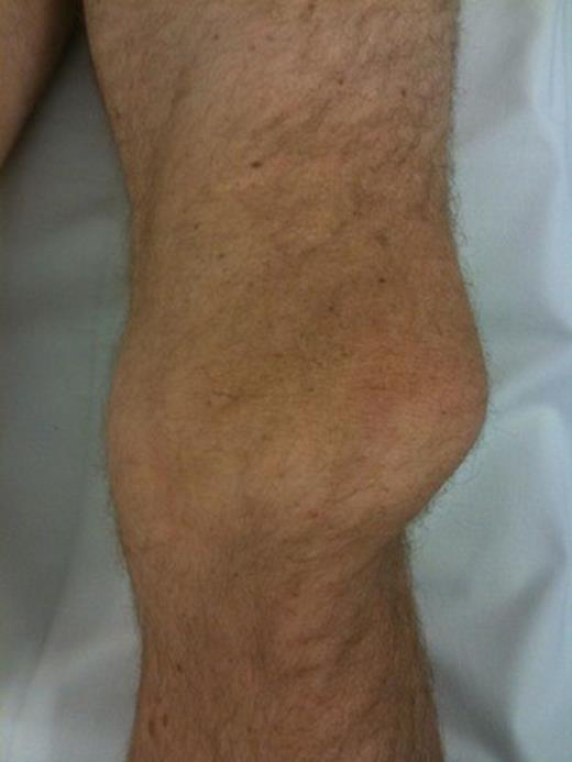 Lateral dislocation of patella with rotation and obvious tenting of skin