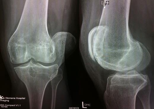 Imaging studies showing lateral dislocation of patella with rotation about long axis, patella locked onto lateral femoral condyle; and insignificant impaction fracture of lateral femoral condyle
