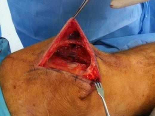 Intra-operative photograph (before reduction) – tear of medial retinaculum with avulsion of medial attachments of patella