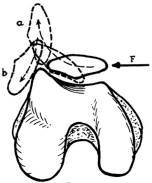 Sketch showing the path patella must take for lateral dislocation with rotation about long axis. (F): direction of dislocating force, (a): position of patella resulting from it sliding up on lateral femoral condyle, (b): final position of patella, where it gets locked, after medial edge clears lateral condyle