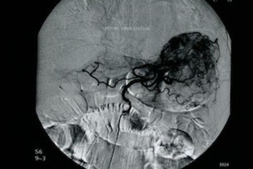 Urgent angiography of the left gastric artery revealed extravasation of contrast material from the gastric body