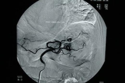 Successful arterial coil embolization, using super selective catheterization in the distal and proximal parts of the ruptured vessel