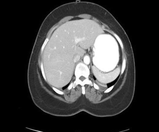 CT scan showing normal appearing liver capsule and no perihepatic fluid collection