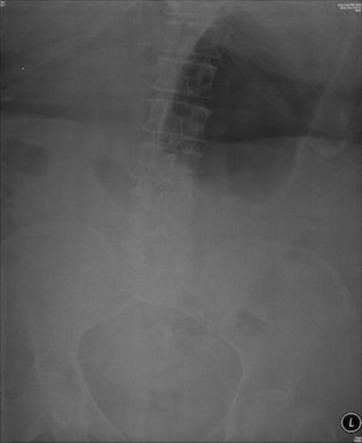 Abdominal x-ray showing huge gas shadow consistent with gastric outlet obstruction
