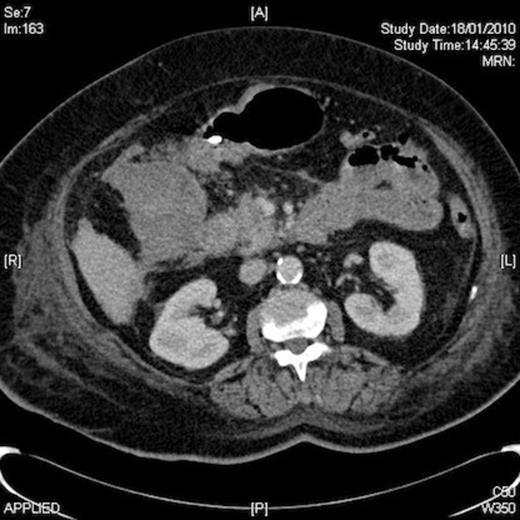 Abdominal CT Scan revealed a 10cm right upper quadrant mass