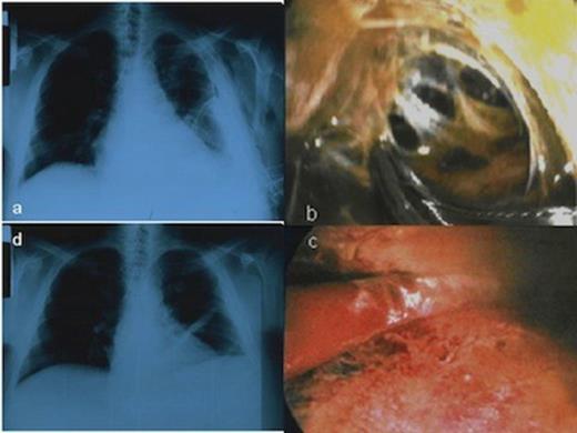 CXR showing the HH and the chest tube in the left hemithorax before the MT, b. Multiloculated thoracic empyema as a complication of HH, c. Disruption of fibrinous adhesions and debridement of parietal and visceral pleura, d. Chest X-ray following MT showed no recurrence of the hydrothorax