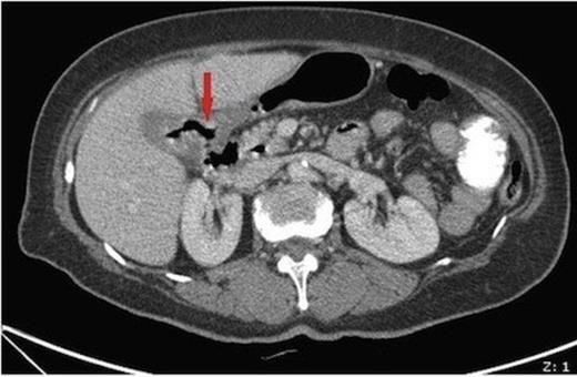 Axial CT image showing a thick walled gallbladder with inflammatory changes and a fistula to the adjacent duodenum