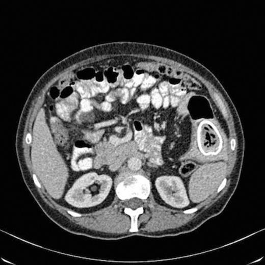 CT scan showing oval calcification in a segment of the small bowel in the left flank situated within a diverticulum with thickening of the small bowel wall at that level