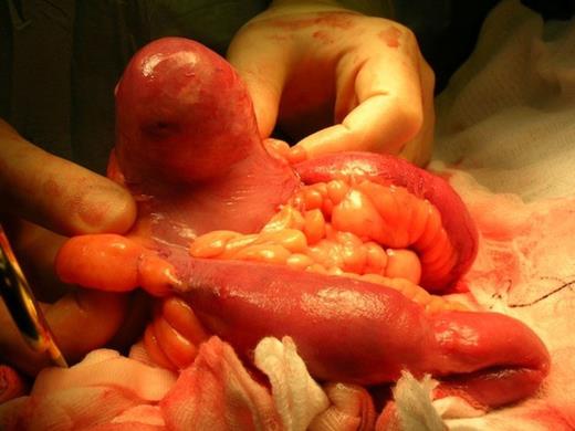 Operative image showing a solid inflammatory 6cm mass within a Meckel's diverticulum