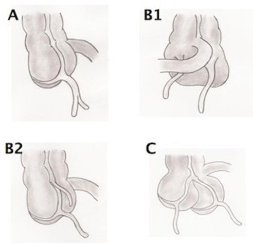 Cave-Wallbridge Classification: Type A: Single caecum with one normally localised appendix exhibiting partial duplication. Type B1: Two appendices located symmetrically on either side of the ileocaecal valve. Type B2: One appendix arises from the caecum at the usual site and the second branches at varying distances along the taenia from the first. Type C: Double caecum, each bearing its own appendix.