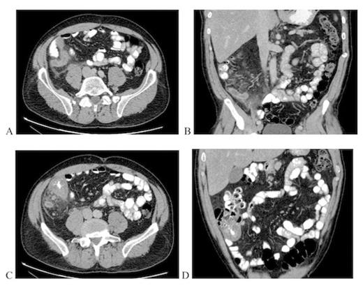 Computed tomography images obtained preoperatively. Axial (a) and coronal (b) views of inflamed appendix. Axial (c) and coronal (d) views of thickened caecal wall and adenopathy.