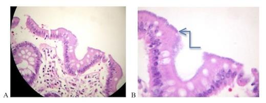 Histopathology of appendix and cecum (a): Appendix. Eosinophils and neutrophils predominantly visualized in appendix mucosa. (H&E staining, light microscopy, magnification x 200) (b): Caecum. Note false brush border (arrow) composed of intestinal spirochetosis adhering to caecal mucosal epithelium. (H&E staining, light microscopy, magnification x 400)