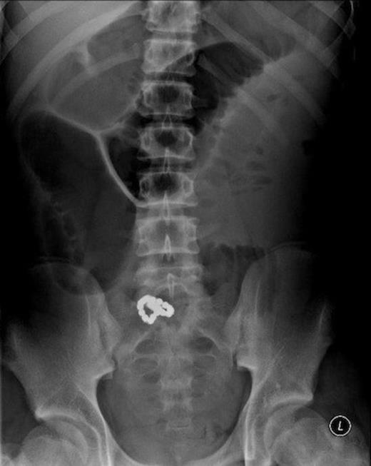 Pre-operative plain abdominal radiograph showing a chain of small magnetic balls within the small bowel with bowel obstruction.