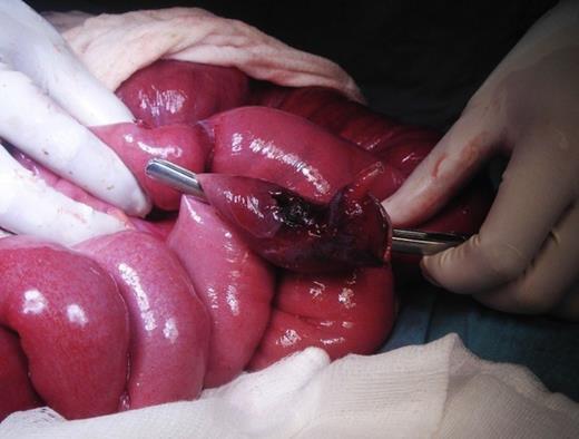 Intraoperative photograph showing Meckel's diverticulum and surrounding necrotic small bowel with perforation.