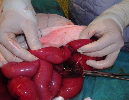 Intraoperative photograph showing a section of jejunum with band adhesion causing necrosis (band previously divided).