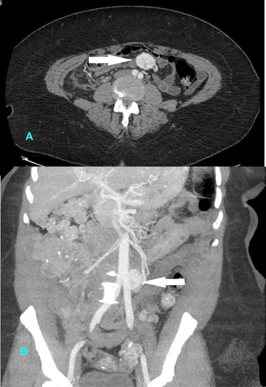 CT Scan showing 3.3 cm avidly enhancing mass (arrow) in the small bowel mesentery with arterial supply from the superior mesenteric artery (A) horizontal and (B) coronal section