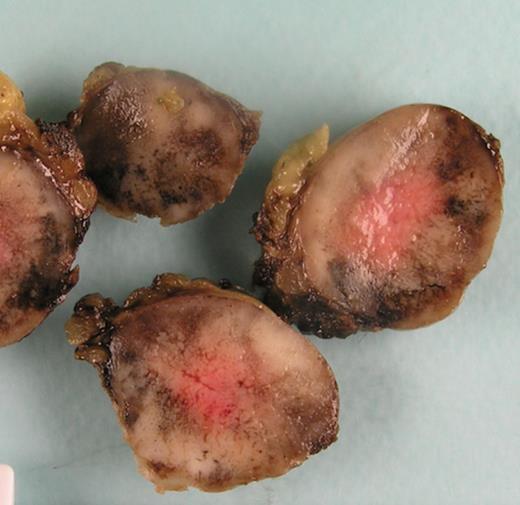 Macroscopic appearance of section through mesenteric paraganglioma