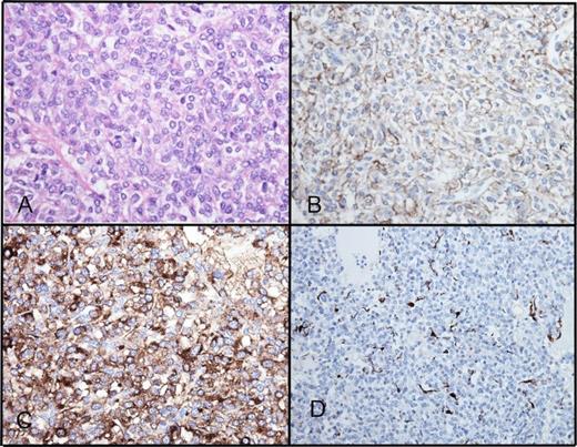 Histology of mesenteric paraganglioma. (A) H&E x400, (B) CD56 immunostaining, (C) chromogranin immunostaining, (D) S100 immunostaining of sustentacular cells
