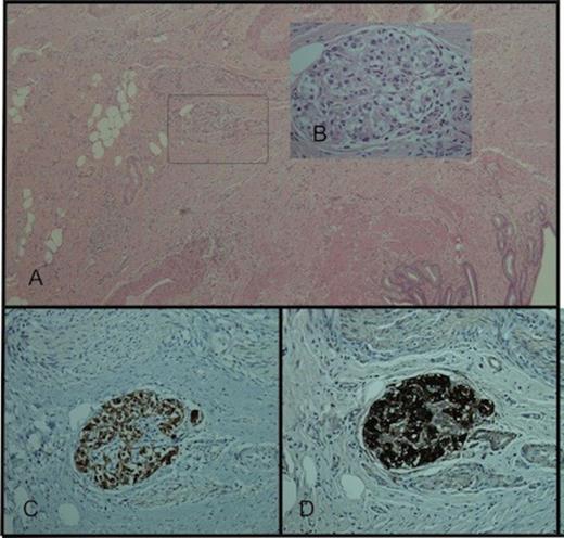 (A) Paraganglion cell rest within the gallbladder wall. H&E staining ×40, (B) H&E staining ×400, (C) synaptophysin immunostaining ×200, (D) chromogranin immunostaining ×200