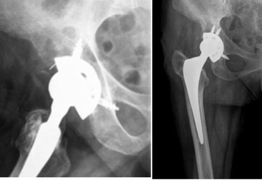 Right hip radiographs (lateral and AP) at the initial evaluation with osteolysis in zones I and II of De Lee and Charnley suggestive of cup loosening
