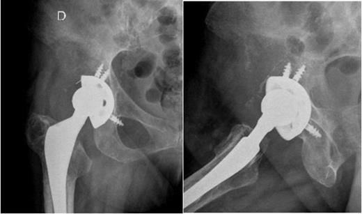 Right hip radiographs (AP and lateral) at the admission, two months later, with an extensive osteolytic lesion in the right iliac wing