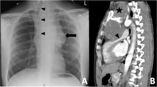 Patient CXR (Figure 1A) with a large shadow (black arrow) of the mass in the superior mediastinum. Due to its size the trachea was displaced far to the right (black arrow head). Sagital views of the CT scan (Figure 1B) showed the mass (black star) in the superior mediastium extending inferiorly into the anterior mediastinum causing obstruction of the right ventricular outflow (black arrow head). The aortic arch was also pushed posteriorly.