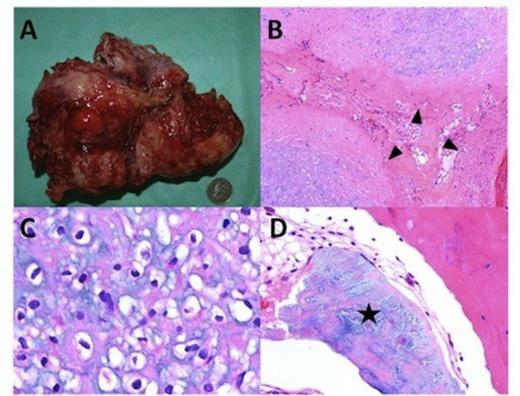 A 170x120x70 mm mass weighing 675 grams was removed. (Figure 2A) The mass was lobulated (Figure 2B) with the lobules separated by thick collagenous bundles (black arrow head). The tumour cells comprised of mature chondrocytes (Figure 2C) which showed minimal atypia. No necrosis or mitoses was seen. However metaplastic bone formation (Figure 2D) was observed (black star). These findings were consistent with those of a well differentiated chondrosarcoma.