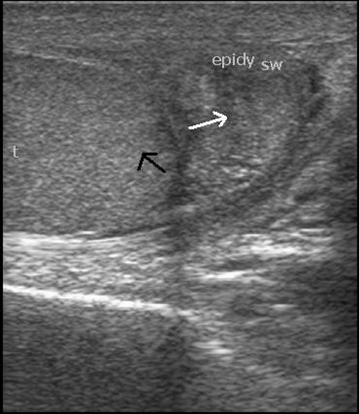 Scrotal ultrasonography. Well defined hypoechoic lesion of size 18x11mm in right epididymis (white arrow) and normal right testis (black arrow)