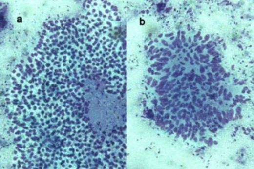 Photomicrograph of FNAC smears showing a). monolayered sheets of cells with indistinct cells borders and pale vacuolated cytoplasm b). stromal cells (Romanowsky x 200)