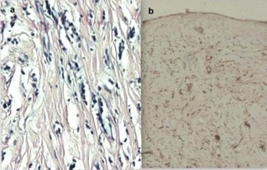 Photomicrograph showing a) Histopathological features of adenomatoid tumor consisting of dilated tubular structures lined by cuboidal to flattened epithelial cells (H and E x 200). b) Immunohistochemical positivity for calretinin (IHC x 100)