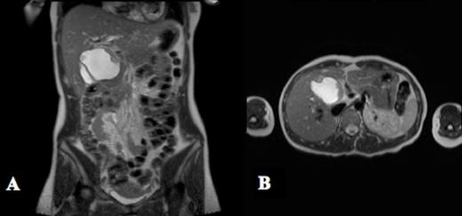 MRCP shows a fusiform dilation of the extrahepatic common bile duct measuring 7.4 x 4.8 x 6.2 cm in the axial (A) and transverse planes (B). There is an enhancing soft tissue mass with a thickness of 1.1 cm protruding into the lumen of the cyst that is concerning for malignancy
