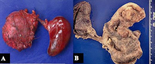 Gross image of choledochal cyst and gallbladder. A shows unopened specimen with cyst on left and gallbladder on right. B shows dissected cyst on right and gallbladder on left.