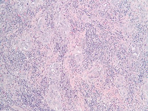 H&E stain (x 200) demonstrates poorly differentiated adenonocarcinoma with focal squamous changes.