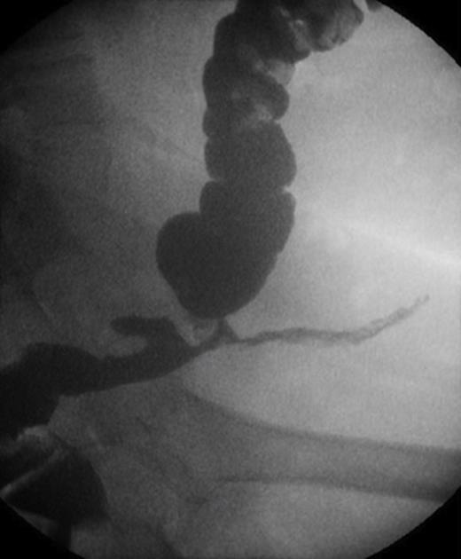 Contrast study showing stricture and fistula tract