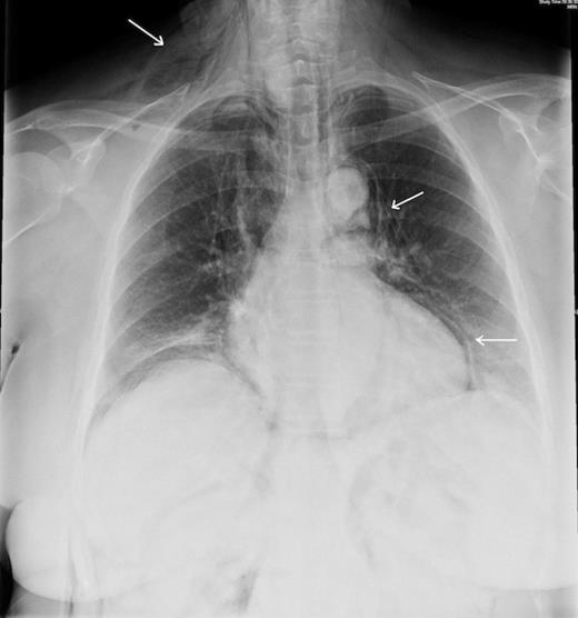 CXR showing subcutaneous emphysema, pneumomediastinum and pneumopericardium