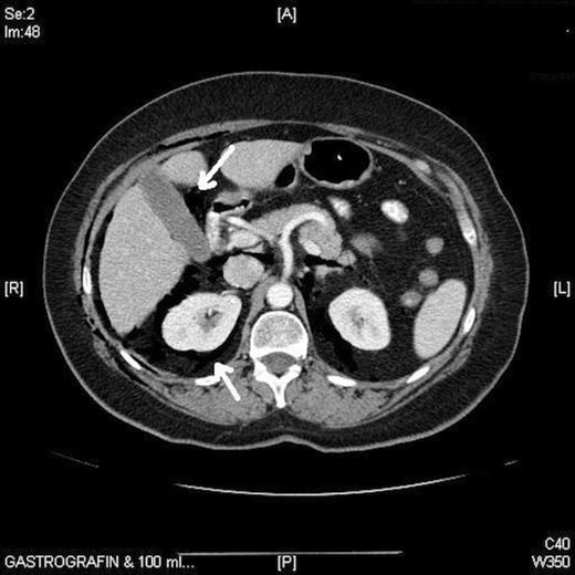 CT showing pneumoperitoneum and pneumoretroperitoneum