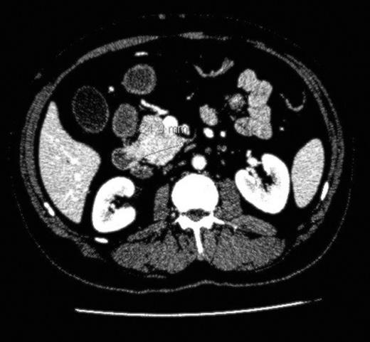 Lesion in uncinate process of the pancreas