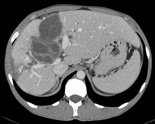 Abdominal CT scan: multiple hydatid cysts in the right lobe of the liver, one of them near the hepatic confluence