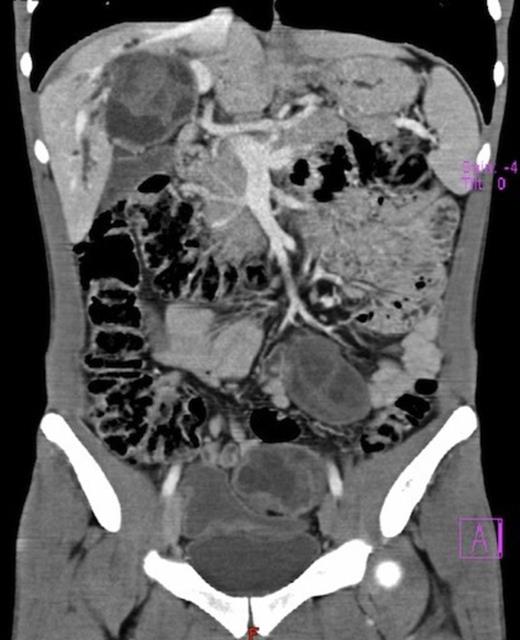 Abdominal CT scan showing disseminated peritoneal hydatidosis.
