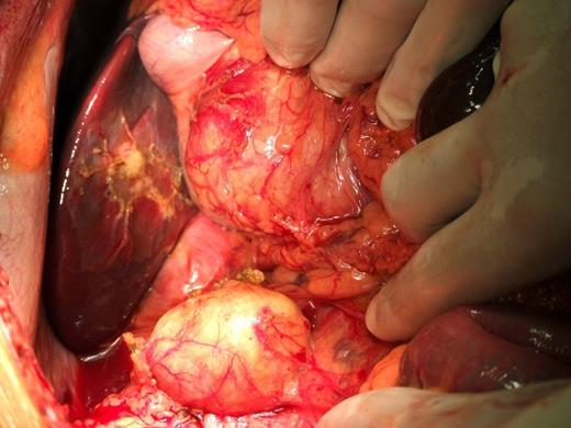 Multiple peritoneal cysts near the gallbladder and sub-hepatic.