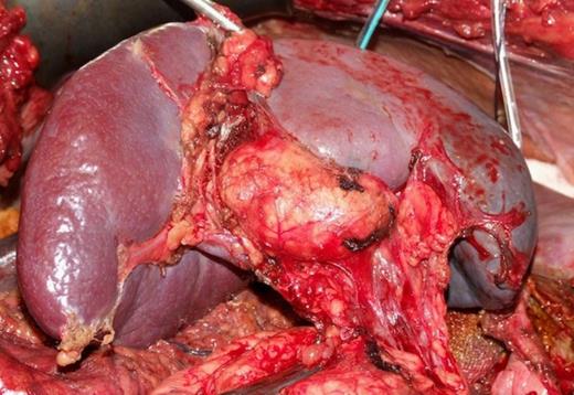 Hydatid cyst involving the splenic hilum.