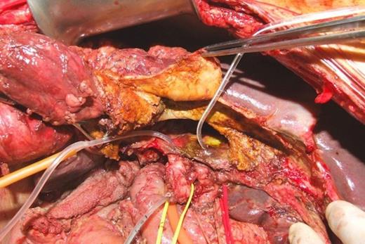 Hepatic hydatid cyst in segments 4 and 5, after inactivation and evacuation, involving the hepatic confluence, with total destruction of the right hepatic duct and fistula formation to the left hepatic duct.