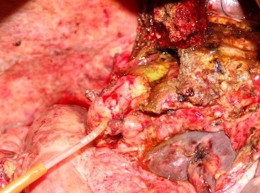 Biliary reconstruction: hepaticocholedocostomy, over a T-tube.