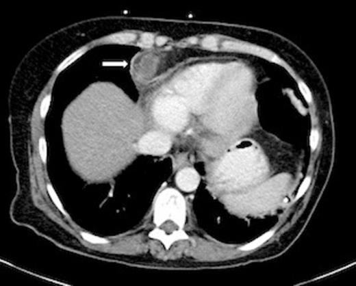 Axial CT Chest showing anterior inferior mediastinal abscess (Arrow).
